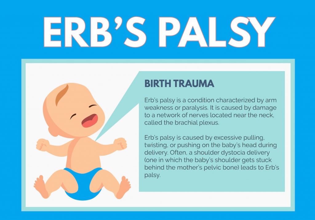 Common causes of ERB Palsy