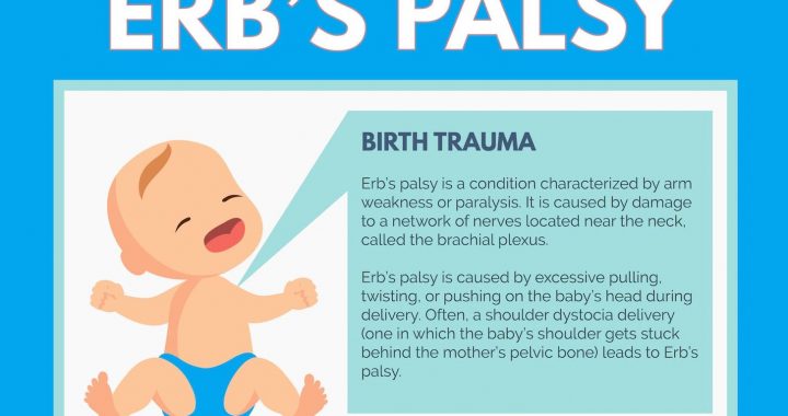 Common causes of ERB Palsy